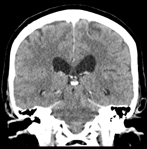 Cerebellar metastasis (Radiopaedia 54578-60812 Coronal C+ 35).png