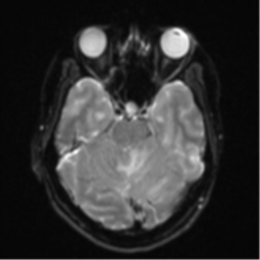 Cerebellar metastasis - adenocarcinoma lung (Radiopaedia 63184-71715 Axial DWI 10).png