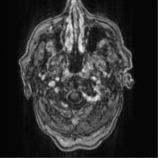 Cerebellar metastasis from lung adenocarcinoma (Radiopaedia 86690-102829 Axial T1 C+ 5).png