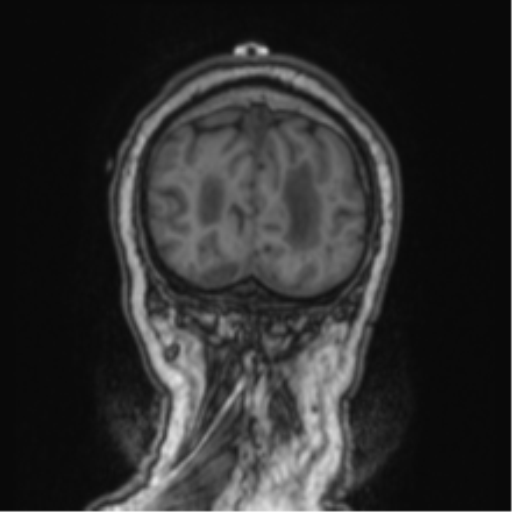 Cerebellar metastasis from lung adenocarcinoma (Radiopaedia 86690-102829 Coronal T1 13).png
