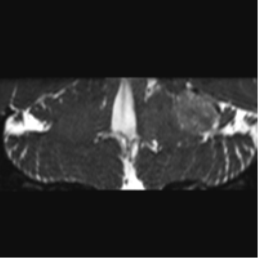 File:Cerebellopontine angle meningioma (Radiopaedia 48434-53348 Coronal T2 30).png