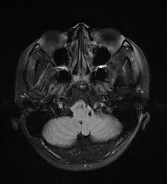 File:Cerebral abscess (Radiopaedia 24212-24478 Axial FLAIR 3).jpg