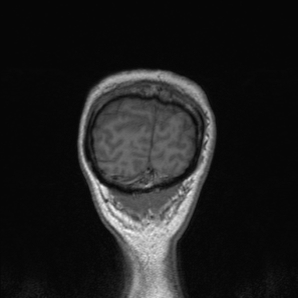 Cerebral abscess (Radiopaedia 24212-24478 Coronal T1 182).jpg