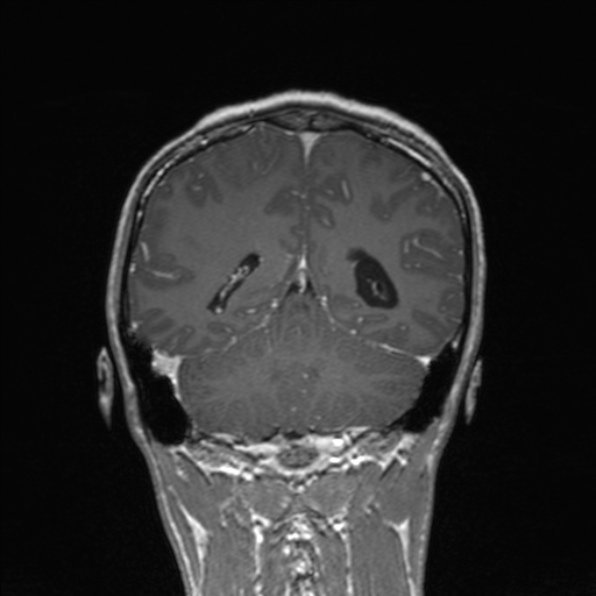 Cerebral abscess (Radiopaedia 24212-24478 Coronal T1 C+ 146).jpg