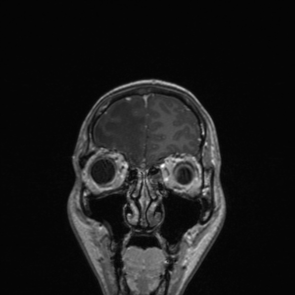 Cerebral abscess (Radiopaedia 24212-24478 Coronal T1 C+ 47).jpg