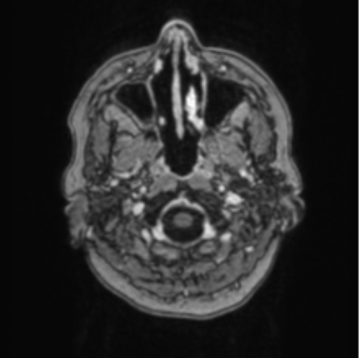 Cerebral abscess from pulmonary arteriovenous malformation (Radiopaedia 86275-102291 Axial T1 C+ 7).png