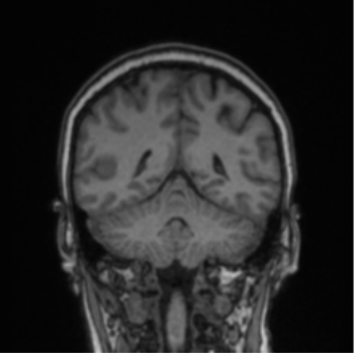Cerebral abscess from pulmonary arteriovenous malformation (Radiopaedia 86275-102291 Coronal T1 32).png