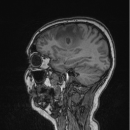 Cerebral abscess from pulmonary arteriovenous malformation (Radiopaedia 86275-102291 Sagittal T1 67).png