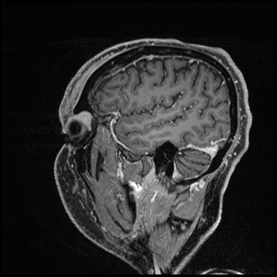 Cerebral abscess with ventriculitis (Radiopaedia 78965-91878 Sagittal T1 C+ 41).jpg