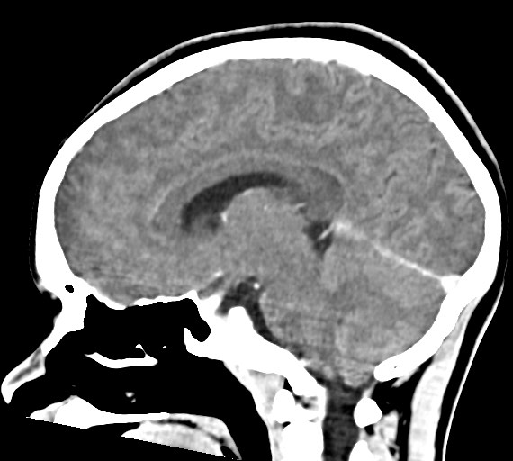 Cerebral abscesses (Radiopaedia 70458-80568 Sagittal Contrast 32).jpg