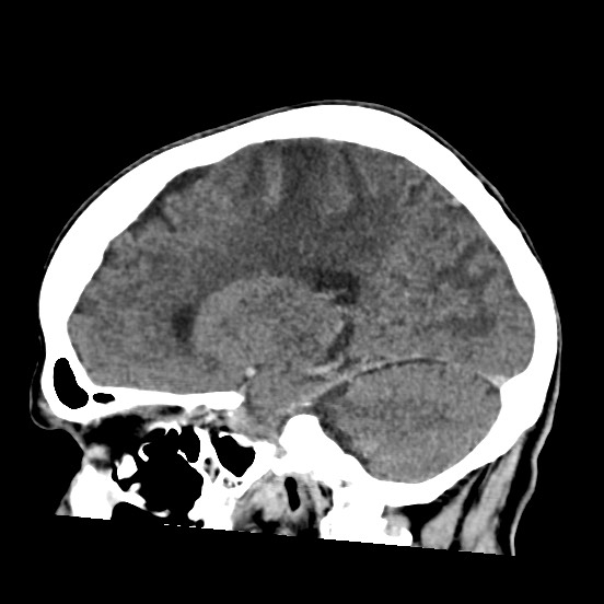 Cerebral amyloid angiopathy-related inflammation (Radiopaedia 74836-85848 C 24).jpg