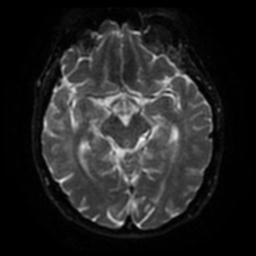 Cerebral amyloid angiopathy (Radiopaedia 28698-28978 Axial DWI 40).jpg