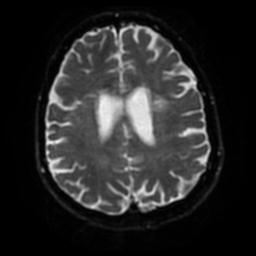 Cerebral amyloid angiopathy (Radiopaedia 28698-28978 Axial DWI 48).jpg