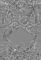 File:Cerebral amyloid angiopathy (Radiopaedia 29129-29518 Axial SWI Phase 7).jpg