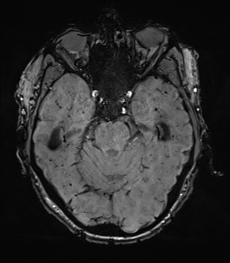 File:Cerebral amyloid angiopathy (Radiopaedia 46082-50433 Axial SWI 26).png