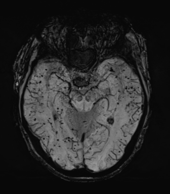 Cerebral amyloid angiopathy (Radiopaedia 46082-50433 Axial SWI MIP 30).png