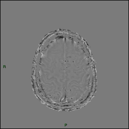 Cerebral amyloid angiopathy (Radiopaedia 77506-89664 H 85).jpg