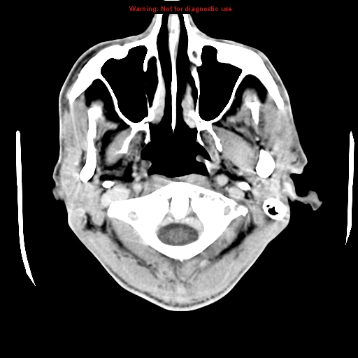 File:Cerebral and orbital tuberculomas (Radiopaedia 13308-13310 B 1).jpg