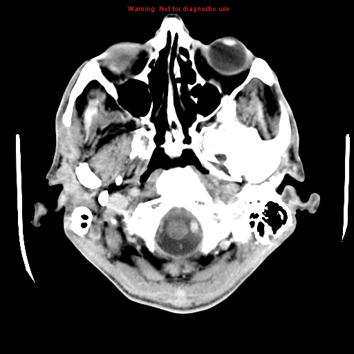 File:Cerebral and orbital tuberculomas (Radiopaedia 13308-13310 B 4).jpg