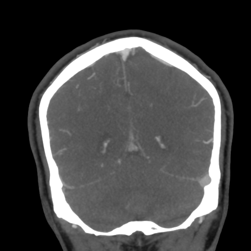 Cerebral arteriovenous malformation (Radiopaedia 39259-41505 E 50).png
