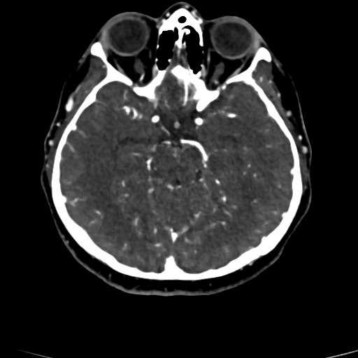 Cerebral arteriovenous malformation (Radiopaedia 73830-84645 Axial C+ delayed 58).jpg