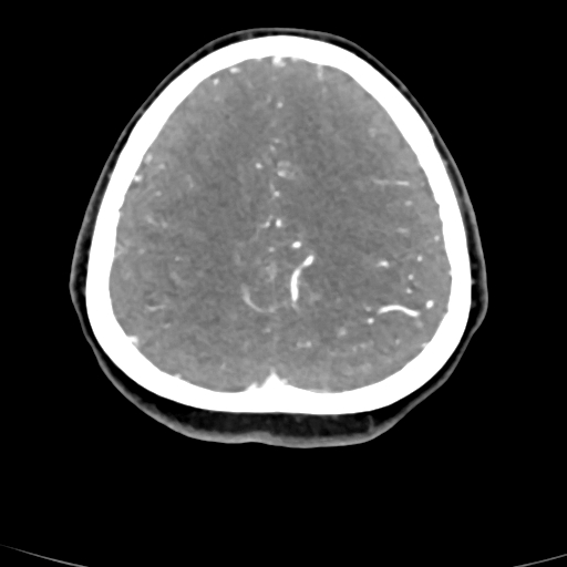Cerebral arteriovenous malformation (Radiopaedia 73830-84645 B 24).jpg