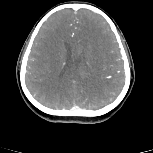 Cerebral arteriovenous malformation (Radiopaedia 73830-84645 B 39).jpg