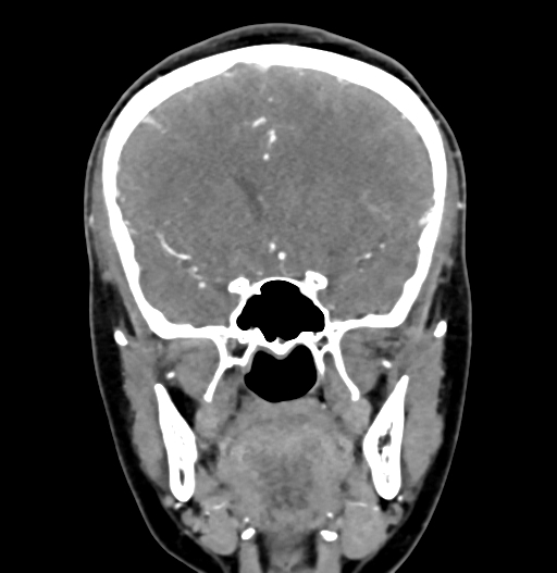 Cerebral arteriovenous malformation (Radiopaedia 73830-84645 C 38).jpg