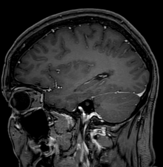 Cerebral arteriovenous malformation (Radiopaedia 74411-85746 Sagittal T1 C+ 34).jpg