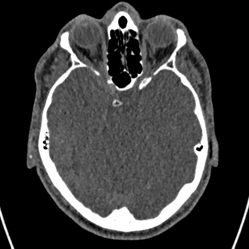 Cerebral arteriovenous malformation (Radiopaedia 78188-90746 Axial non-contrast 59).jpg