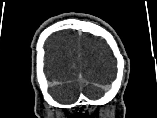Cerebral arteriovenous malformation (Radiopaedia 78188-90746 Coronal C+ delayed 114).jpg