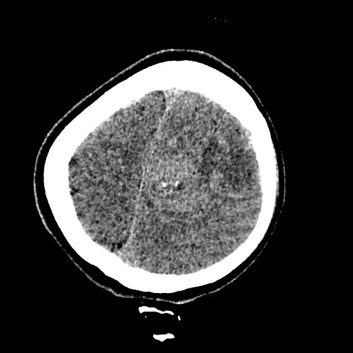 File:Cerebral arteriovenous malformation (Radiopaedia 79677-92887 Axial non-contrast 46).jpg