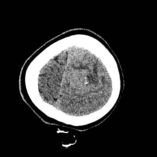 Cerebral arteriovenous malformation (Radiopaedia 79677-92887 Axial non-contrast 56).jpg