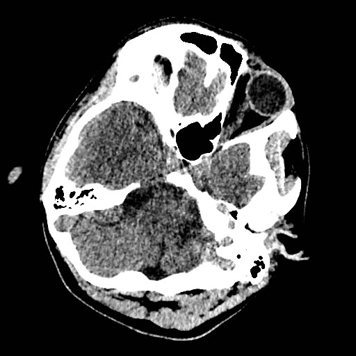 Cerebral arteriovenous malformation (Radiopaedia 79677-92887 Axial non-contrast 6).jpg