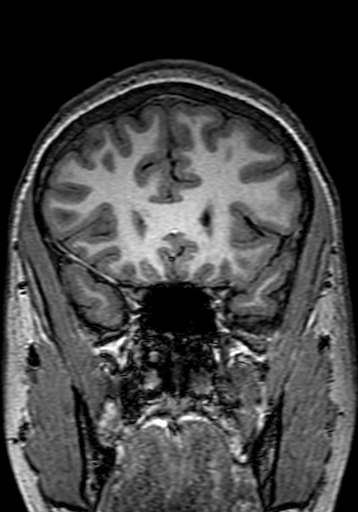 File:Cerebral arteriovenous malformation at posterior body of corpus callosum (Radiopaedia 74111-84925 Coronal T1 86).jpg
