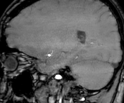Cerebral arteriovenous malformation at posterior body of corpus callosum (Radiopaedia 74111-84925 J 265).jpg