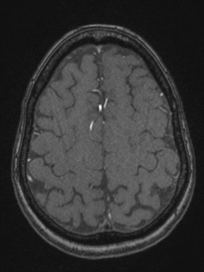 Cerebral arteriovenous malformation with hemorrhage (Radiopaedia 34422-35737 Axial MRA 67).png