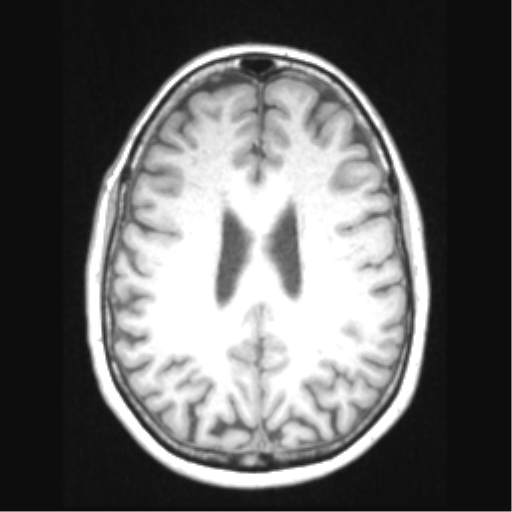 File:Cerebral arteriovenous malformation with hemorrhage (Radiopaedia 34422-35737 Axial T1 50).png