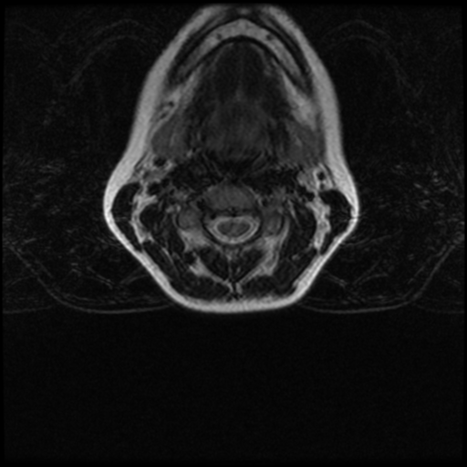 File:Cerebral autosomal dominant arteriopathy with subcortical infarcts and leukoencephalopathy (CADASIL) (Radiopaedia 41018-43763 Ax T2 C2-T1 8).png