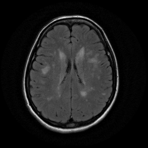 File:Cerebral autosomal dominant arteriopathy with subcortical infarcts and leukoencephalopathy (CADASIL) (Radiopaedia 41018-43763 Ax T2 Flair PROP 13).png
