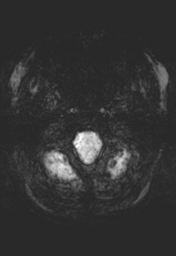 File:Cerebral cavernoma and development venous anomaly (Radiopaedia 37603-39482 Axial SWI MIP 3).png