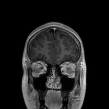 Cerebral cavernous venous malformation (Radiopaedia 70008-80021 Coronal T1 C+ 51).jpg