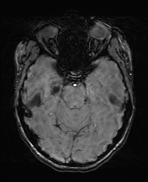 Cerebral cavernous venous malformation (Radiopaedia 70008-80021 I 25).jpg