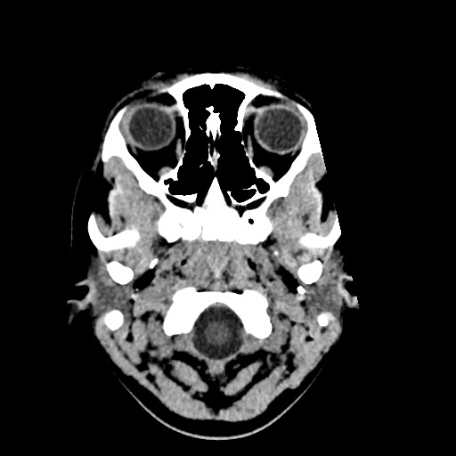 File:Cerebral cavernous venous malformation (Radiopaedia 70008-80022 Axial non-contrast 1).jpg