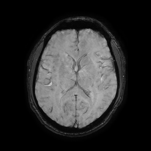 Cerebral cavernous venous malformation (Zabramski type II) (Radiopaedia 85511-101198 Axial SWI 70).jpg