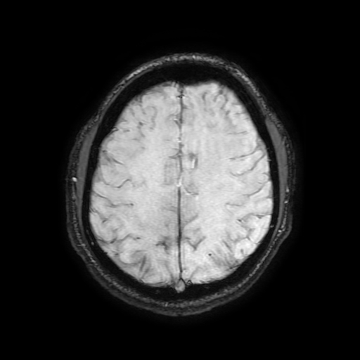 Cerebral cavernous venous malformation (Zabramski type II) (Radiopaedia 85511-101198 Axial SWI 89).jpg