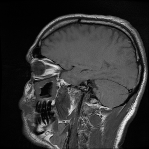 File:Cerebral cavernous venous malformation (Zabramski type II) (Radiopaedia 85511-101198 Sagittal T1 13).jpg