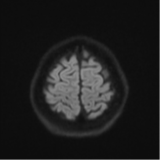 Cerebral cavernous venous malformations (Radiopaedia 48117-52946 Axial DWI 52).png