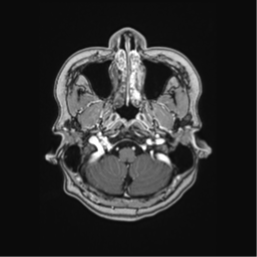 Cerebral cavernous venous malformations (Radiopaedia 48117-52946 Axial T1 C+ 1).png