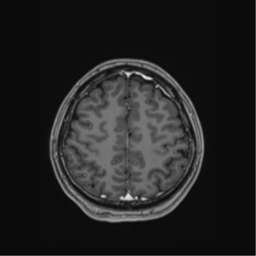 Cerebral cavernous venous malformations (Radiopaedia 48117-52946 Axial T1 C+ 49).png
